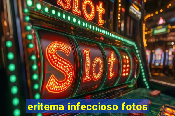 eritema infeccioso fotos