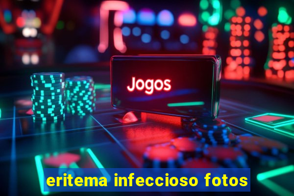 eritema infeccioso fotos
