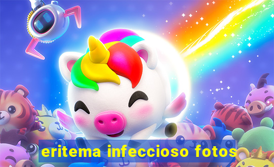 eritema infeccioso fotos